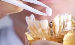 Enhancing Smiles and Restoring Confidence: Charlotte Restorative Dentistry