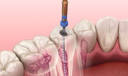 Exploring Root Canal Solutions And Its Costs In Toronto