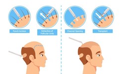 Demystifying Hair Transplants: A Comprehensive Guide to What to Expect