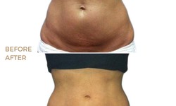 The Journey to a Sculpted Body: SculpSure Before and After Stories