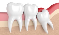 Expert Tips for Relieve Wisdom Tooth Pain