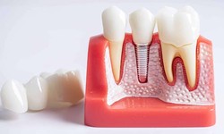 Maximizing Your Smile: A Guide to Dental Implants in Florida