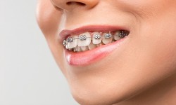 Choosing the Right Orthodontics Clinic Nearby for Your Perfect Braces Fit
