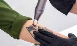 Restore Your Skin's Radiance: Laser Tattoo Removal in Abu Dhabi
