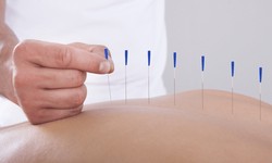 How Can Dry Needling Therapy in Edmonton Improve Your Well-being?