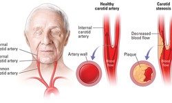 The Connection between Carotid Artery Disease and Peripheral Artery Disease