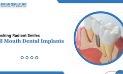Unlocking Radiant Smiles: Full Mouth Dental Implants