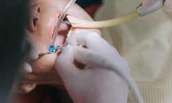 The Ultimate Breakdown of Root Canal Treatment Cost in Abu Dhabi