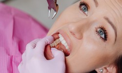 À quoi s'attendre : Processus d'Extraction des Dents de Sagesse à Montréal avec Galerie Dentaire Soleil