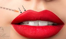 Aesthetic Lip Enhancement: Achieve the Perfect Pout