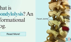 What is Spondylolysis? An Informational Blog.