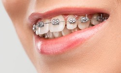 Braces in Dubai - How Do You Choose the Right Type of Braces?