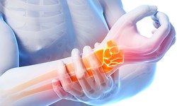 Chiropractic Beneficial for Carpal Tunnel.