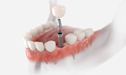 Dive into Excellence: Dental Implants in Abu Dhabi