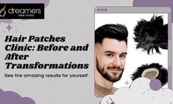 Your Trusted Hair Restoration Destination in Chandigarh and Mohali