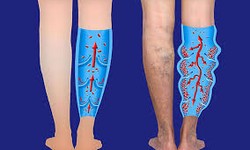 The Connection between Varicose Veins and Cardiovascular Health