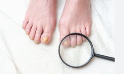 OVERCOMING ONYCHOMYCOSIS REVIEWS FOR CURING FUNGAL INFECTION