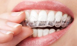 How Much Does Invisalign Costs In New York City?