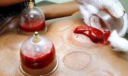 Can You Do Hijama on Your Period?