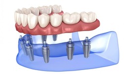 Dental Implant Cost - Thibodaux La