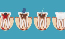 Treatment Of  Root Canal In Toronto By Specialists