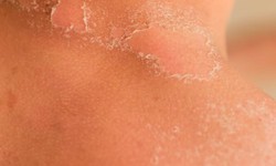 Nurturing Your Skin: Effective Strategies to Combat Severe Dryness