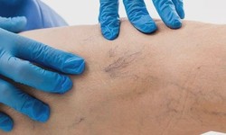 Sclerotherapy Solutions: Enhancing Vascular Health in Abu Dhabi