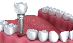 Dubai's Specialists in State-of-the-Art Dental Implants