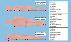 Understanding and Managing Venus Leg Ulcers, and Pressure Ulcers on Feet!