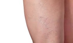 Radiant Legs, Confident You | Exploring Spider Veins Treatment Solutions