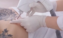 Revitalize Your Skin: Effective Laser Tattoo Removal in Abu Dhabi
