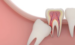 Tips for Selecting Wisdom Teeth Extraction Services in Windsor