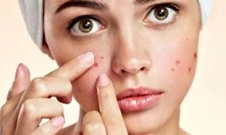Over-the-Counter vs. Prescription Acne Medications: What Works Best in Abu Dhabi?