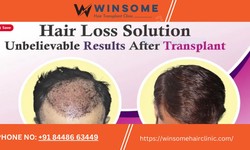 The Hair Transplant For High Grade Baldness Can Help You Regain Your Personality