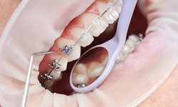 Enhancing Oral Health: The Role of Dental Braces in Healthcare