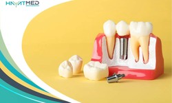 Exploring the Affordable and High-Quality Tooth Implant Options in Turkey