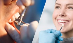 Invest in Your Smile: Exploring the Advantages of Dental Veneers