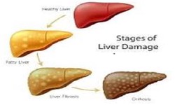 Comprehensive Healthcare Solutions: Liver Disease Treatment in Ghatkopar