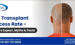 Understanding the Success Rate of Hair Transplants in India: Factors and Considerations