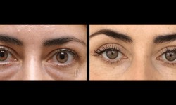 The Impact of Eyelid Lift Surgery on Vision: Improving Sight and Enhancing Aesthetics