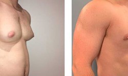 Am I Too Young For Undergoing Gynecomastia Surgery?