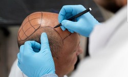 Crowning Glory: Witness the Magic of Afro Hair Transplant Results