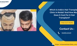 Which Is India’s Hair Transplant Clinic In Noida? And How Much Does It Cost For A Hair Transplant?