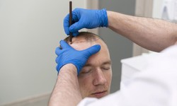 Dubai's FUE Hair Transplant Center: Excellence in Restoration