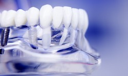 Smile Restoration 101: Exploring Dental Implants as a Solution