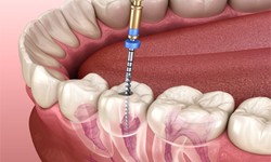 Root Canal Treatment: Cost and Benefits in Dubai