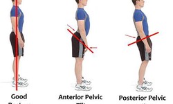 Understanding Lordosis: Causes, Symptoms, and Effective Treatments
