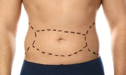 Experience Transformation: Tummy Tuck Surgery in Dubai with Dr. Anshu