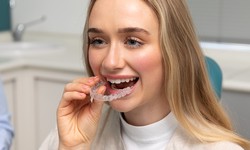 Lingual Braces: A Discreet Solution for Orthodontic Treatment