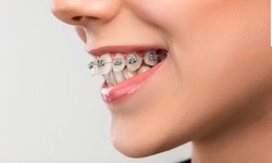 Finding Top Quality Dental Implants Near You: Your Go-To Guide